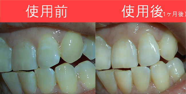 歯の黄ばみの取組みを検証